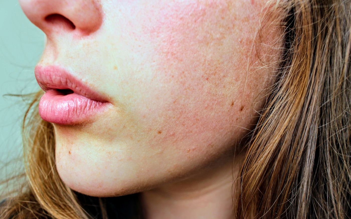 Melasma e manchas